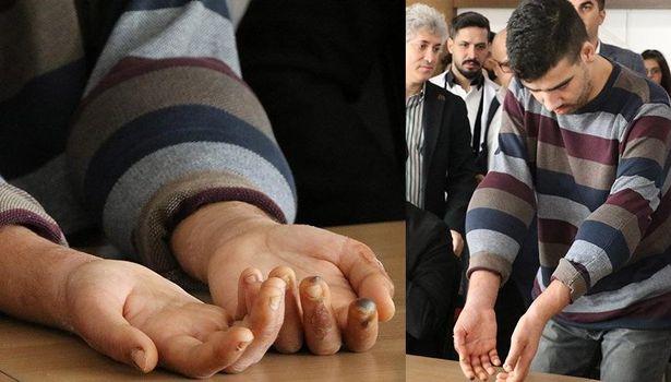 Çift kol nakli yapılan Şimşek: Elimi kolumu sallaya sallaya yürümek istiyorum