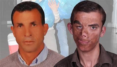 İlk yüz nakli yapıldı
