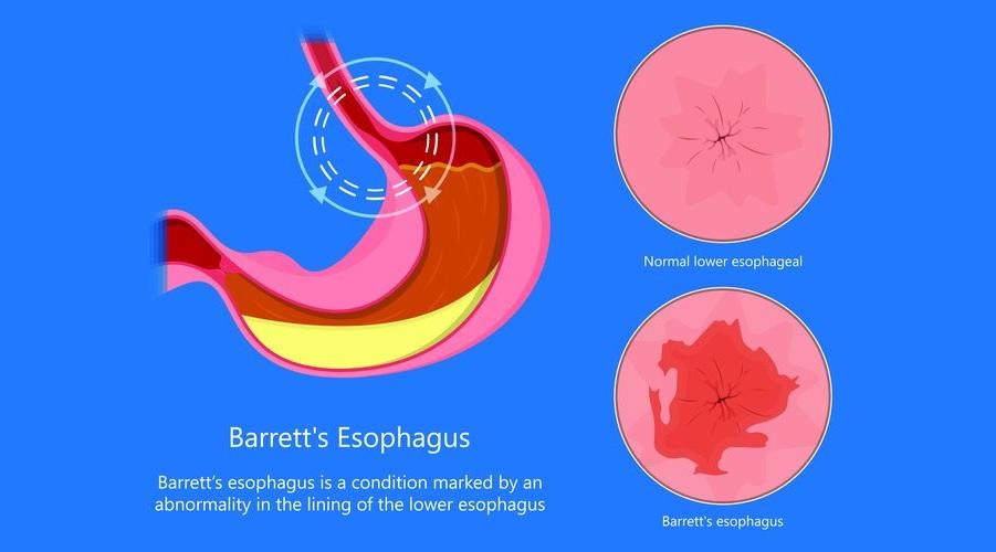 Antireflü ameliyatı Barrett özofagusunda kanser riskini azaltmayabilir
