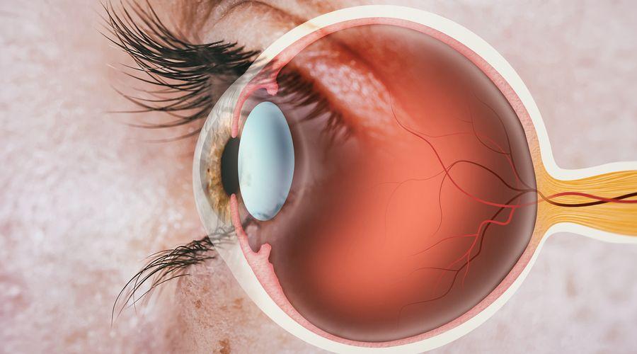 Araştırmacılar, kolesterol birikimi ve diyabetik retinopati arasındaki bağlantıyı ortaya çıkardı