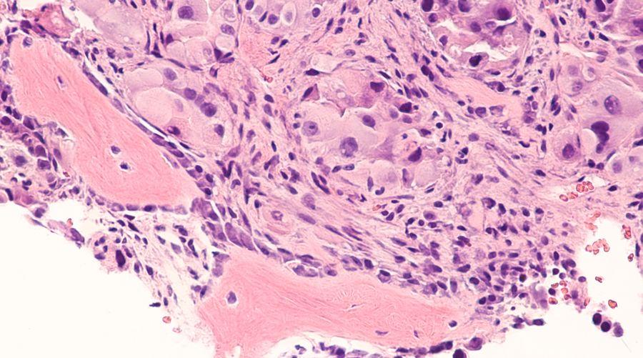 Neoplazi ve displazi farkları: Sağlığınız için bilmeniz gerekenler