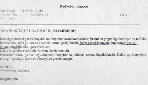 Safra kesesi; hastada yok, raporda homojen ve normal büyüklükte!