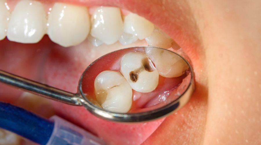 Çocuklarda bilinçsiz antibiyotik kullanımı diş sağlığını tehdit ediyor