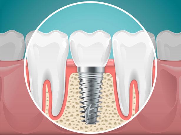 COVID-19 erken implant düşmelerine neden olabilir