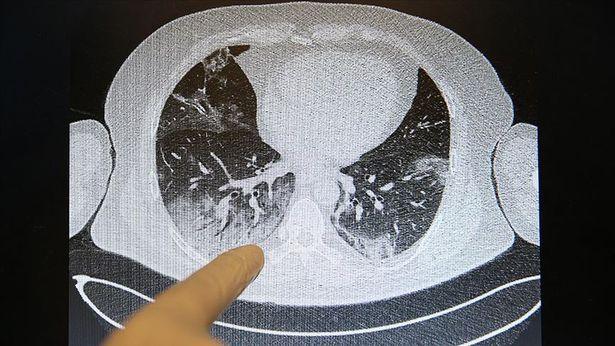 'COVID-19 tomografilerinde akciğer kanseri saptamak mümkün'