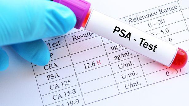 Prostat kanseri taraması 5 yıl içinde mümkün olabilir
