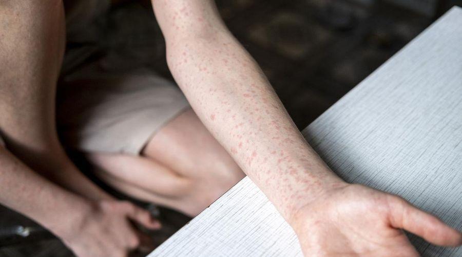 ABD’de kızamık vakaları 33 yılın zirvesinde