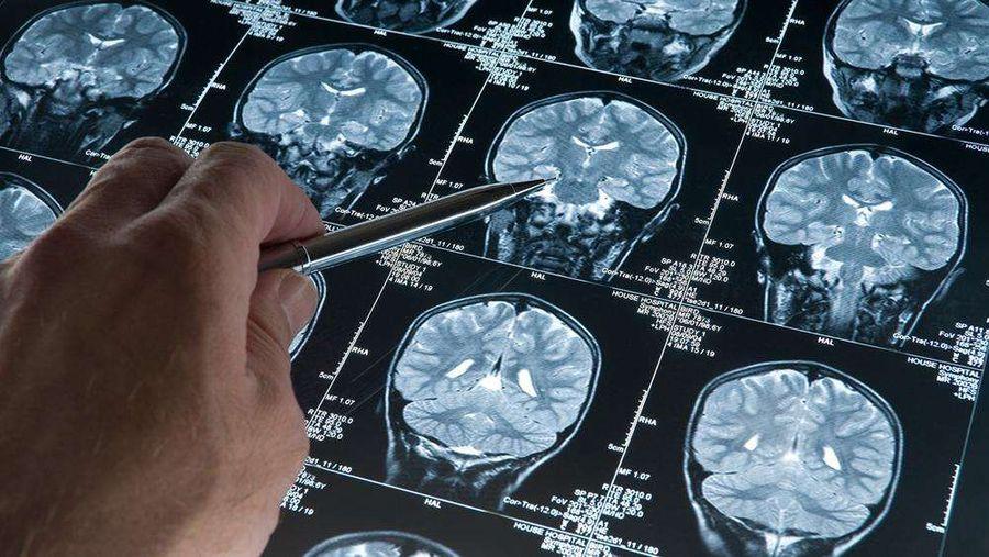 Araştırma: Alzheimer bulguları genç yaşlarda ortaya çıkabilir