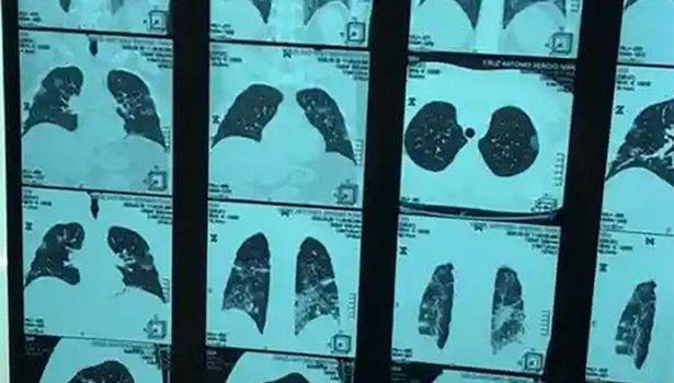 Koronavirüsten hayatını kaybeden doktorun ailesi akciğer grafisini paylaştı!