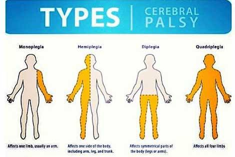 Yeni bulgular Celebral Palsye yaklaşımı değiştirecek