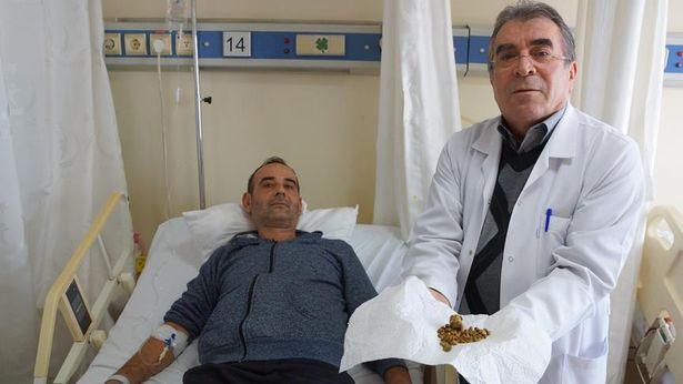 Doktor şoke oldu: Karın ağrısının sebebi 250 tane taş 