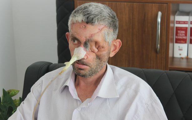 İlaçlarını almayınca gözünü kaybeden hasta, diş hekimine dava açtı!