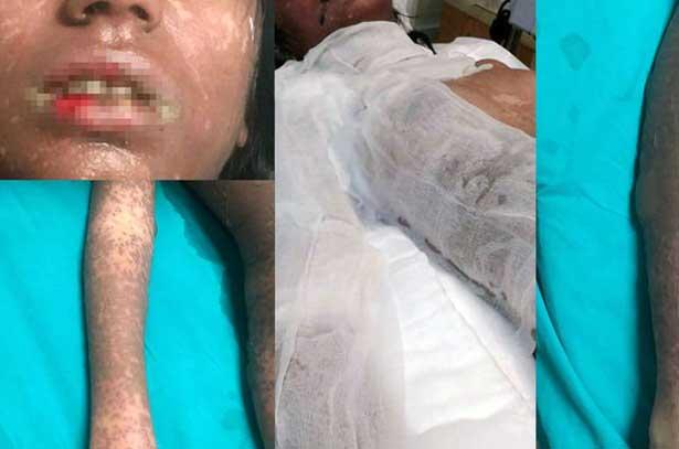 İlaç yan etkisi olarak Stevens Johnson sendromu ortaya çıktı, İlacı yazan doktor hastaneye çağırıldı!