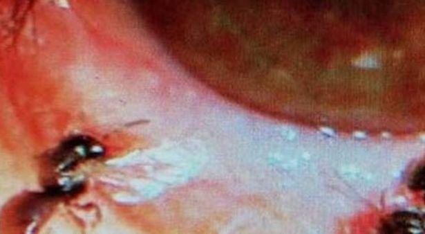 Enfeksiyon kapan gözden arılar çıktı: 'Gözyaşıyla beslendiler'