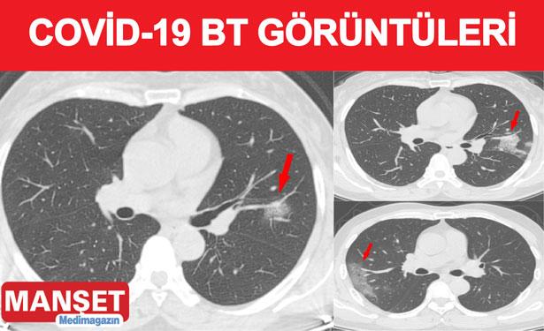 Araştırma: Covid-19 için en iyi teşhis yöntemi tomografi