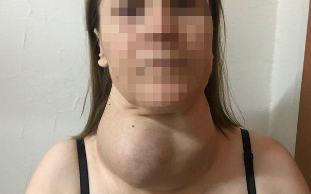 Ameliyat korkusu ile boynunda dev guatr ile yaşadı: 30 yıl sonra ikna oldu