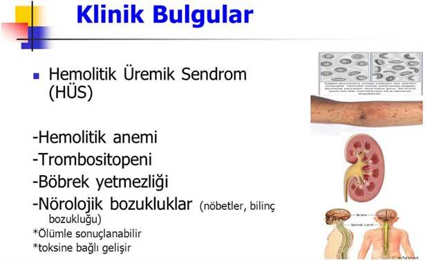 Hastaneye komada gelen ve Hemolitik üremik sendrom teşhisi konan küçük Zeynep sağlığına kavuştu