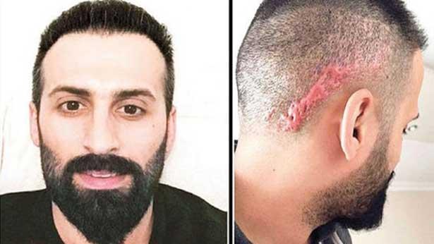 Saç ekimine 'taksirle yaralama' soruşturması