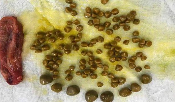Karın ağrısıyla gittiği hastanede safra kesesinden 120’ye yakın taş çıkarıldı