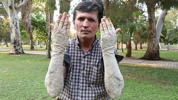 Sedef hastalığı ile savaşan hastaya doktor desteği... Bütün masraflarını karşıladı! 