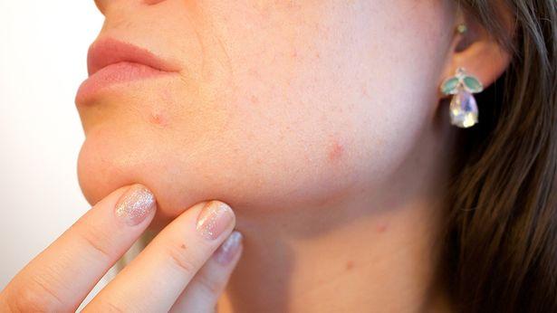 Türk Dermatoloji Derneği uyardı: Tedavi edilmeyen sivilceler kalıcı iz bırakıyor