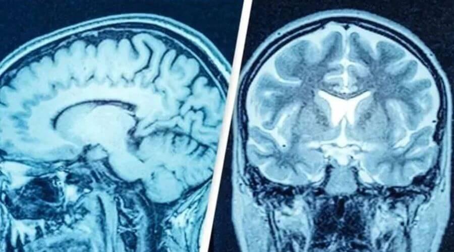 Bilim insanlarını şaşırtan vaka: Neredeyse hiç beyni olmadan hayatta kalan adam