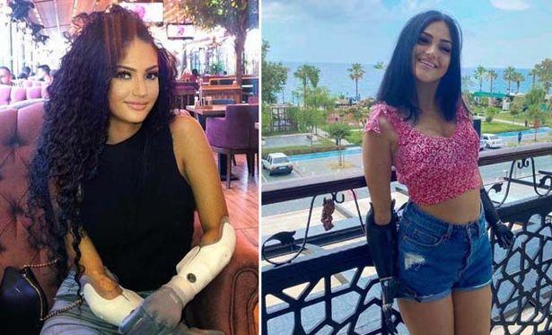 Meningokok hastalığı nedeni ile kollarını kaybeden genç kız, çift kol nakli için Türkiye'ye geldi