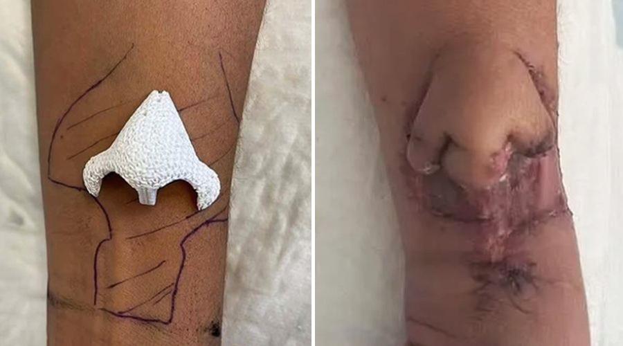Fransa'da çığır açan tedavi: Kolunda büyüttükleri burnu yüzüne naklettiler!