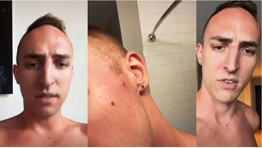 Maymun çiçeği virüsü bulaşan doktor semptomları gösterdi: 'Yüzümde, boynumda, kollarımda…'