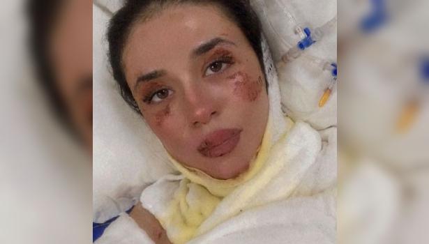  Acil servisteki patlamada yaralanan hemşire: Herkesin gözü önünde yandım
