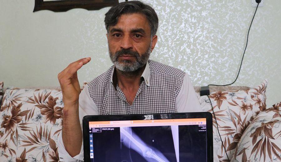 Elindeki şişlik için gittiği hastanede 'kolundan 2 kez yanlış ameliyat oldu' iddiası