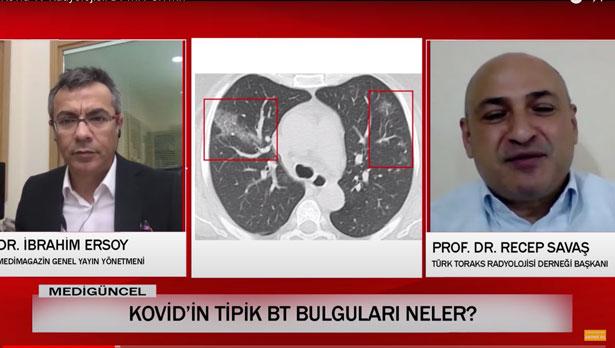 Sorularla Kovid 19 Radyolojisi: Tanıda, hasta takibinde ve tedavide  BT ve akciğer grafisinin rolü ne oldu?