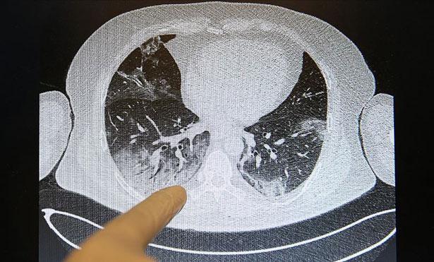 Kovid-19'un akciğerlere verdiği zarar tomografi görüntülerine yansıyor