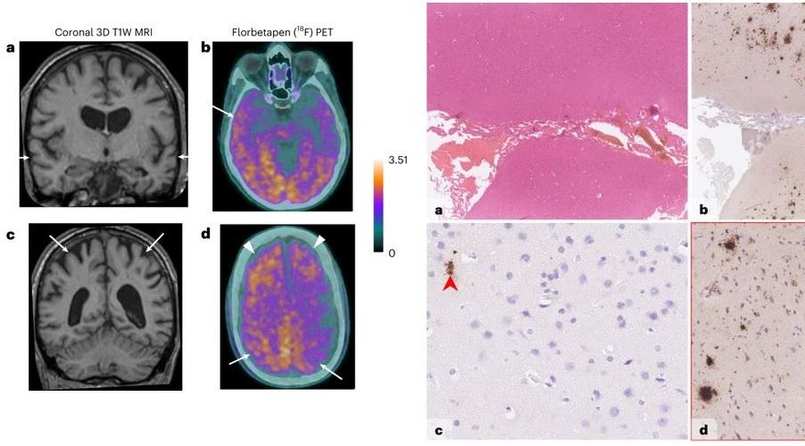Alzheimer'la ilgili ilk kez bulaş kanıtı bulundu