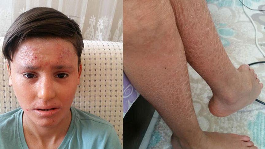 'Balık pulu' hastası Kayra, gündüzleri evden çıkamıyor