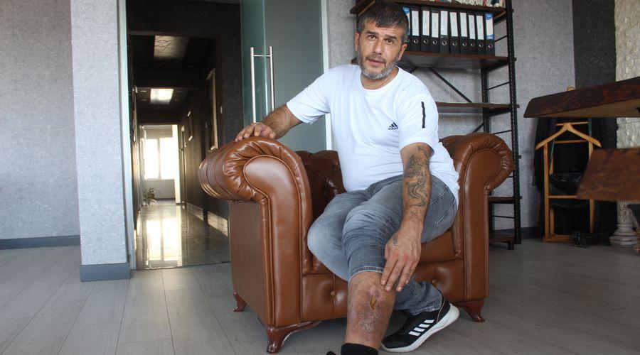 Girdiği ameliyatta bacağında unutulan parçayla 16 yıl yaşadı
