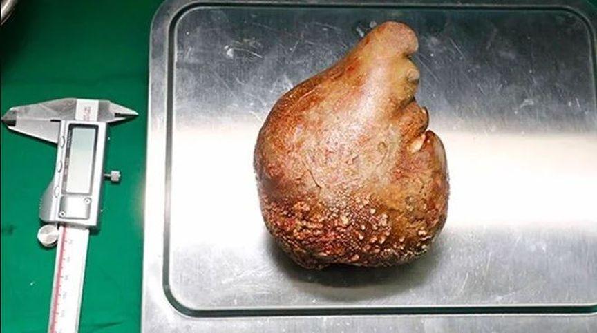 Dünyanın en büyük böbrek taşı çıkarıldı: 801 gram ağırlığında