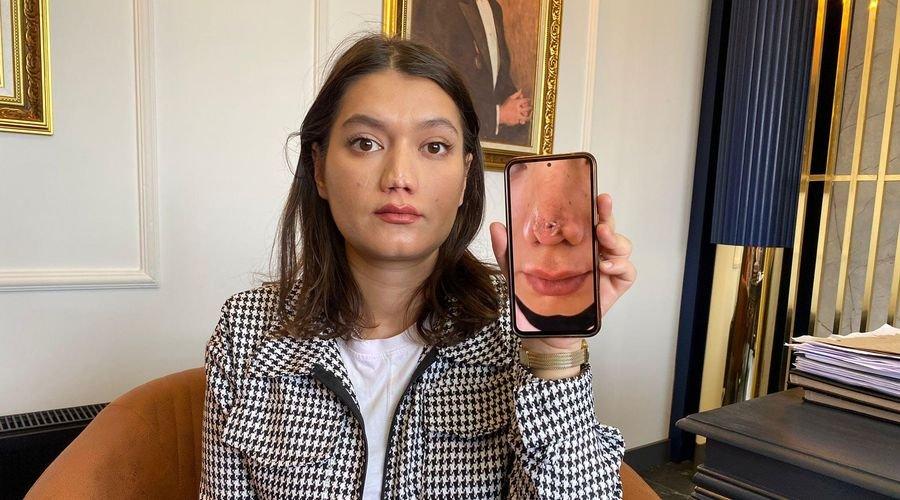 Ameliyatta burun estetiğinin bozulduğu iddiasıyla 1 milyon liralık tazminat davası açtı