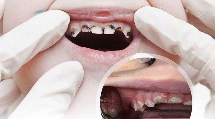 Çocukların ağzındaki büyük tehlike: Erken çocukluk çağı çürükleri
