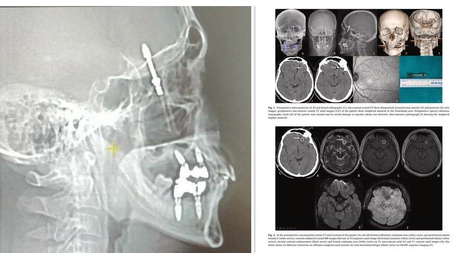 Diş implantı, çene kemiği ile 'orbita tabanı'nı delip, beyin omurilik sıvısına girdi