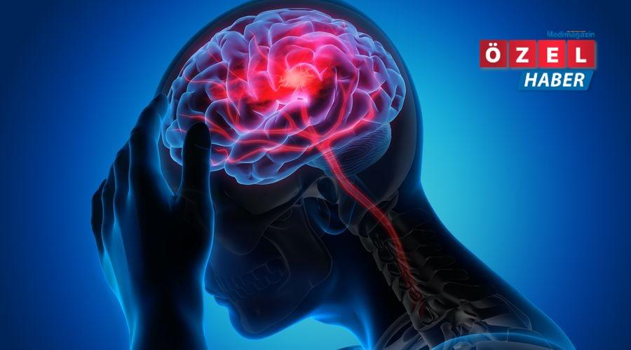 Yeni çalışma statinlerin ilk kanamalı inmeden sonra tekrarlayan iskemik inme riskini azaltabileceğini gösteriyor