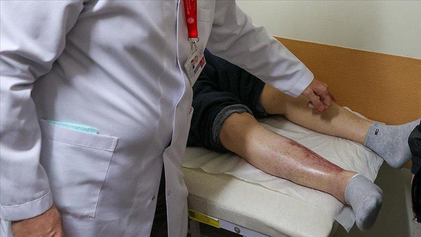 Kapanmayan yaralarından kök hücre tedavisiyle kurtuldu