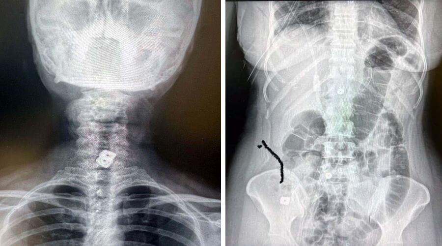 Tıp literatüründe nadir vaka: Boynuna takılan implant midesine düştü