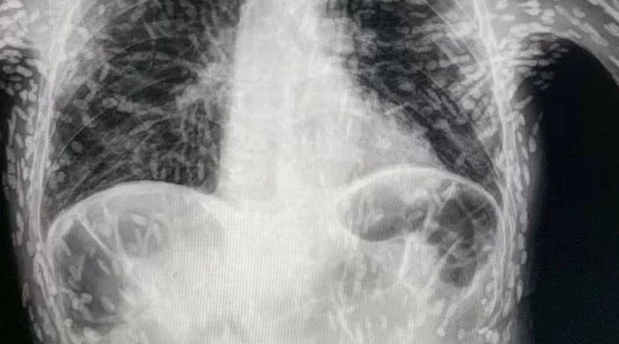 Doktorları şaşırtan görüntü: Tenyalar organlarını delik deşik etti