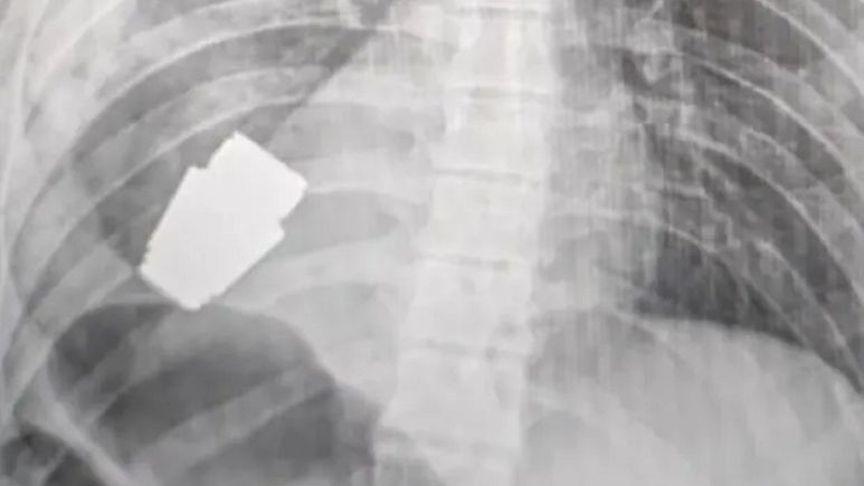 Ukraynalı askerin göğsündeki patlamamış el bombası ameliyatla çıkarıldı