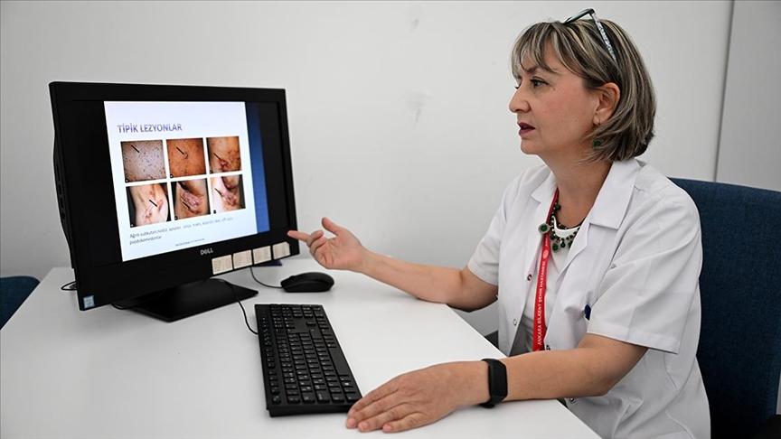 Derideki ağrılı nodüller 'hidradenitis süpürativa' belirtisi olabilir