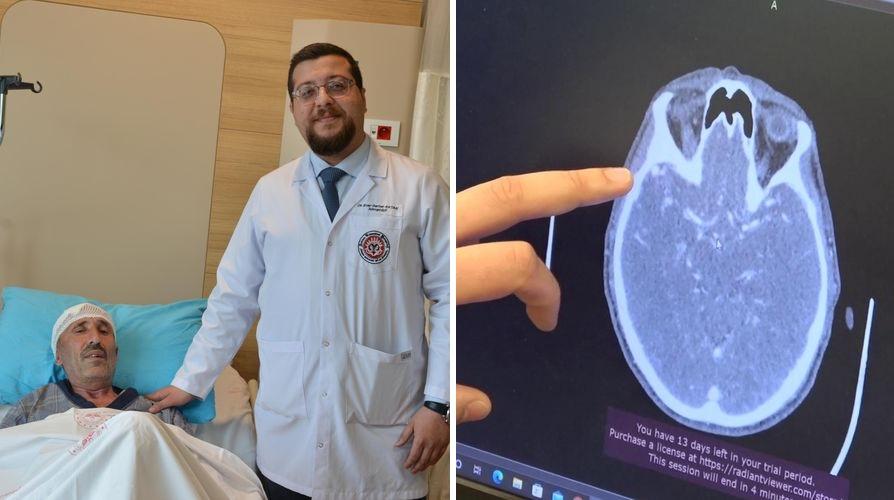 Atardamar ve toplardamarın beyinde oluşturduğu damar yumağını 5 saatte temizlediler