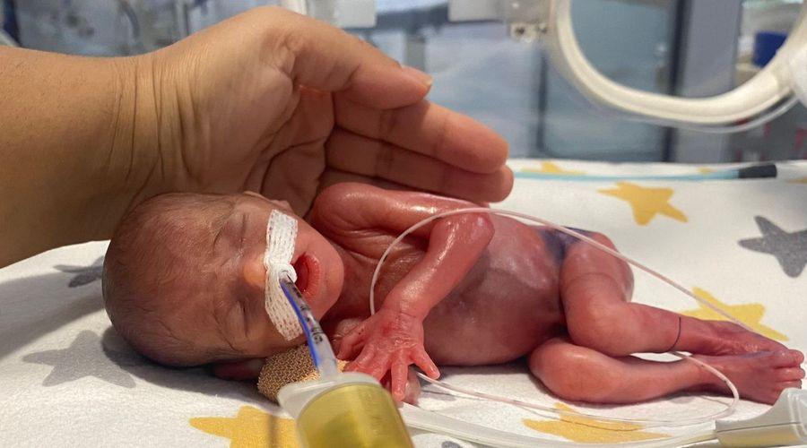 380 gram doğmuştu! 155 günlük mücadeleyle hayata tutundu