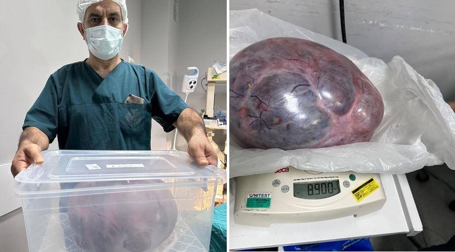 Yumurtalıklarındaki 9 kiloluk kitle operasyonla çıkarıldı