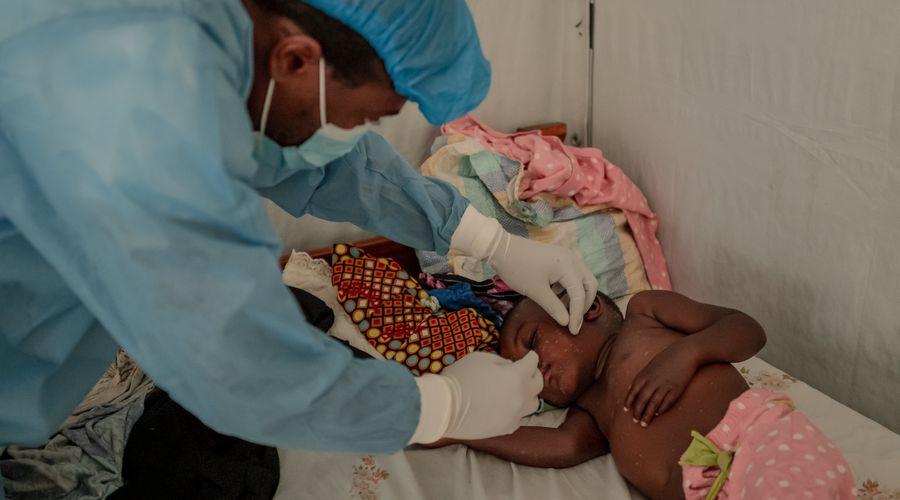 USAID, maymun çiçeğinden etkilenen bölgelere 35 milyon dolarlık yardım sağlayacak